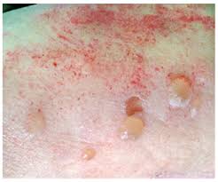 Attēlu rezultāti vaicājumam “Pemphigus borealis”