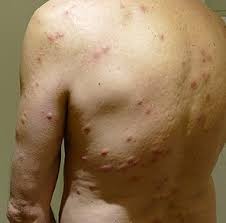 Image result for bed bug bites