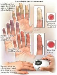 Attēlu rezultāti vaicājumam “Scleroderma”