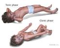 Epilepsy Seizures | About Child