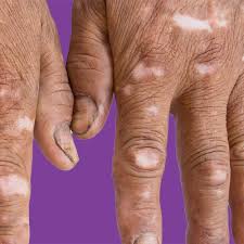 Attēlu rezultāti vaicājumam “Scleroderma”