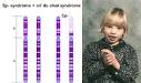 Cri du Chat - Gentic Disease Wiki