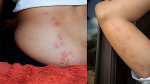 Image result for bed bug bites