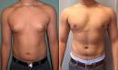 GYNEXIN - Natural Gynecomastia Cure - Does GYNEXIN Really Work or ...