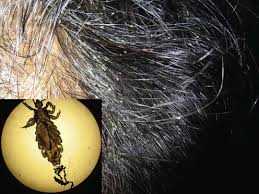 Attēlu rezultāti vaicājumam “Pediculus humanus capitis”