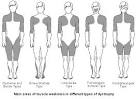 <b>Muscular</b> Dystrophies - An Overview | Health | Patient.