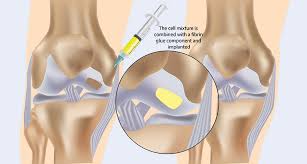 Image result for BMAC