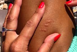 Image result for bed bug bites