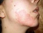 Will chemical peel burn end up as a scar    Chemical peel forum