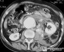 LearningRadiology - Ruptured Aortic Aneurysm