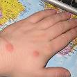 Mark M Simonian MD - Insect bite