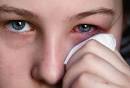 Conjunctivitis Or Pink <b>Eye</b>