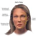 Bell's Palsy