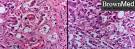 <b>Alcoholic hepatitis</b>