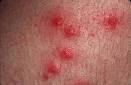 Hot Tub Rash | Salt Chlorinator