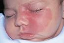 <b>Port</b>-<b>wine stain</b> on infants