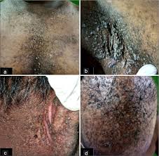 Attēlu rezultāti vaicājumam “Diderma radiatum young”