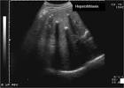 File:<b>Caroli disease</b>