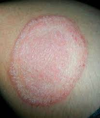 Image result for tinea corporis