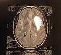 Brain Tumor Pics