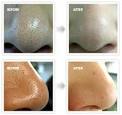 How to Cure Black Heads