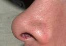 How to Get Rid of Blackheads