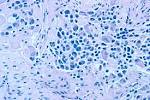 File:<b>Neuroblastoma</b>.jpg