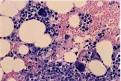 Case Report of agranulocytosis induced by vinpocetine