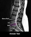 Herniated or Ruptured Disc - Cedars-