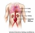 Abdominal Aortic Aneurysms