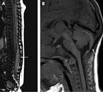 <b>Spinal subdural hematoma</b>