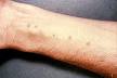 <b>Schistosomiasis</b>