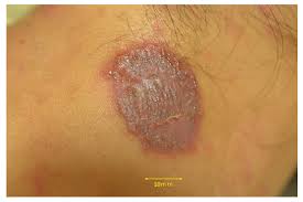 Image result for tinea corporis