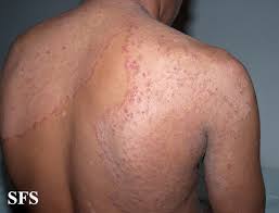 Image result for tinea corporis