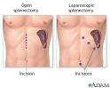 <b>Splenectomy</b> - Removal of