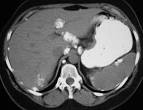 <b>Ovarian Neoplasms</b>