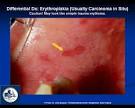 Erythroplakia