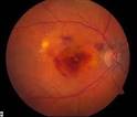 MACULAR DEGENERATION - Ruston Eye and Laser Institute - Jared ...