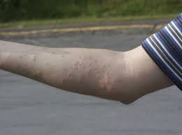 Image result for bed bug bites