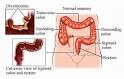 DIVERTICULITIS - Medicalook
