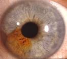 <b>Iris Neoplasms</b>
