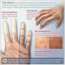 Attēlu rezultāti vaicājumam “Scleroderma”