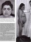 Cushing's Syndrome