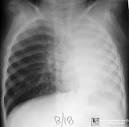 <b>Atelectasis</b>