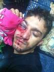 Eye injury: