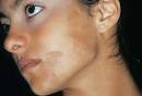 Phytophotodermatitis Hyperpigmentation Picture Image on MedicineNet.