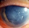Familial <b>Fuchs endothelial</b>