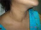 Images related to Thyroid Nodule