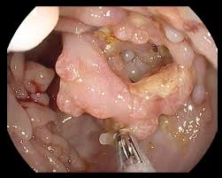 Image result for boala crohn si schizofrenie paranoida