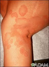 Image result for tinea corporis